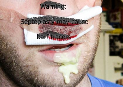 Septoplasty