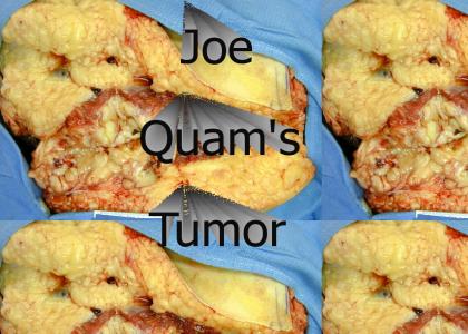 Joe Quam's got a tumor!