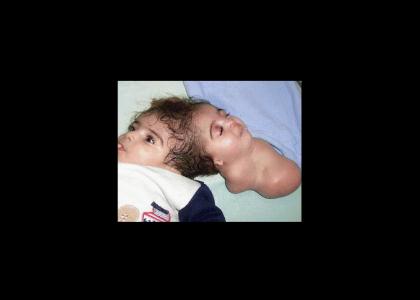 Two-headed baby doesn't change facial expressions