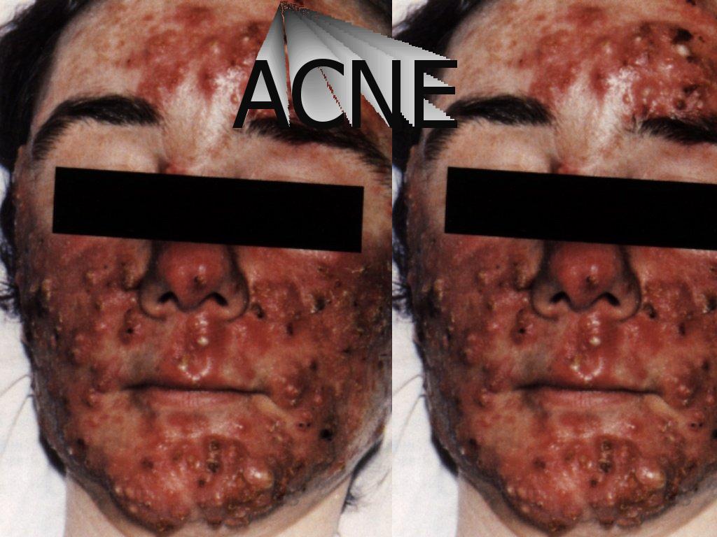 acne4