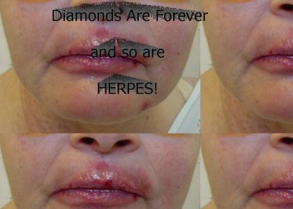 Herpes are Forever