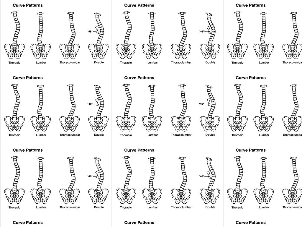 Scoliosis