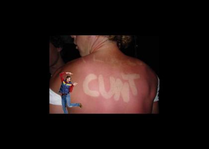 SunBURN can be a real...