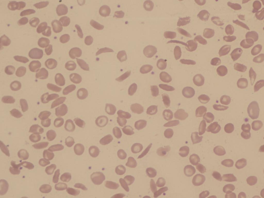 sicklecellanemia