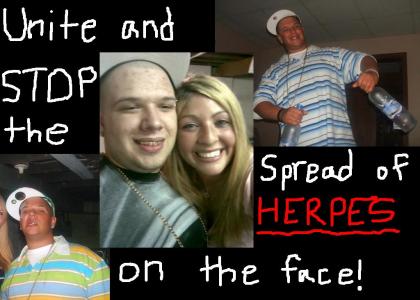 Help Stop the Spread of Herpes on the Face!