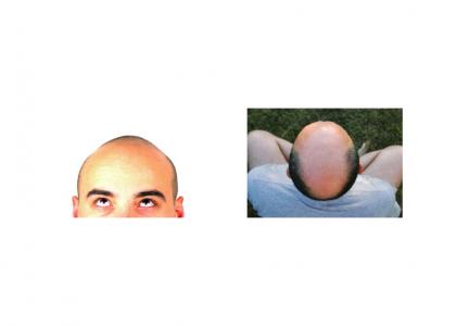 baldness
